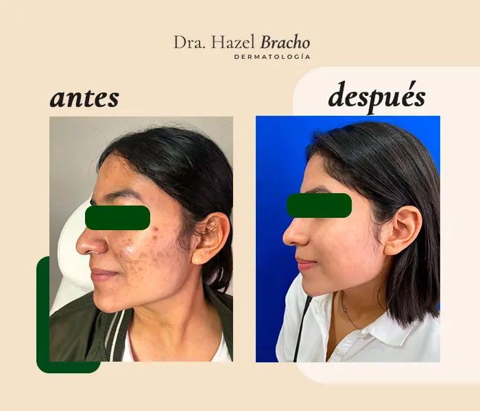 Antes y después de tratamiento dermatológico, caso 1