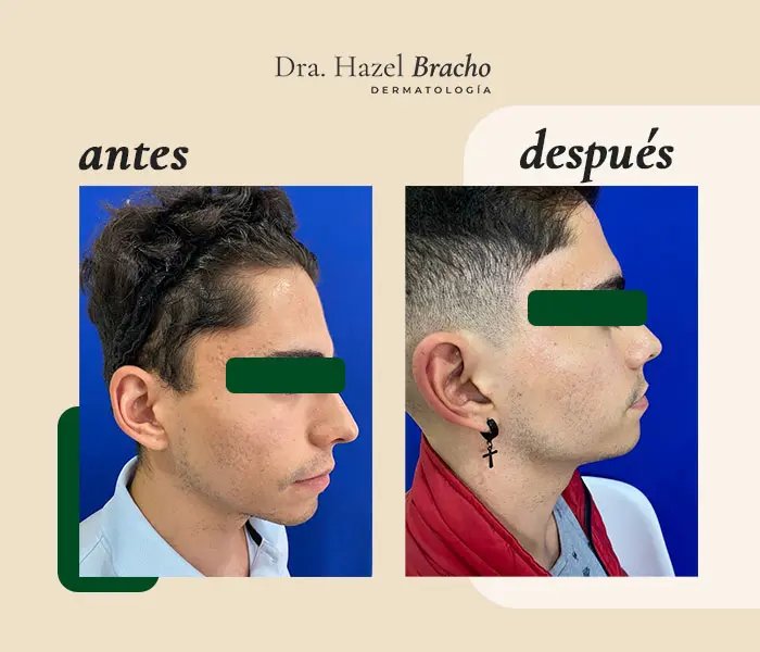 Antes y después de tratamiento dermatológico, caso 2