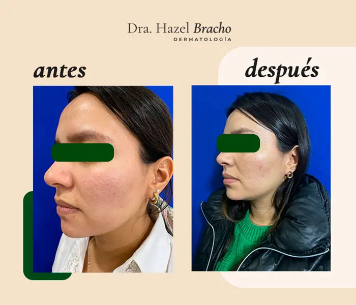 Antes y después de tratamiento dermatológico, caso 3