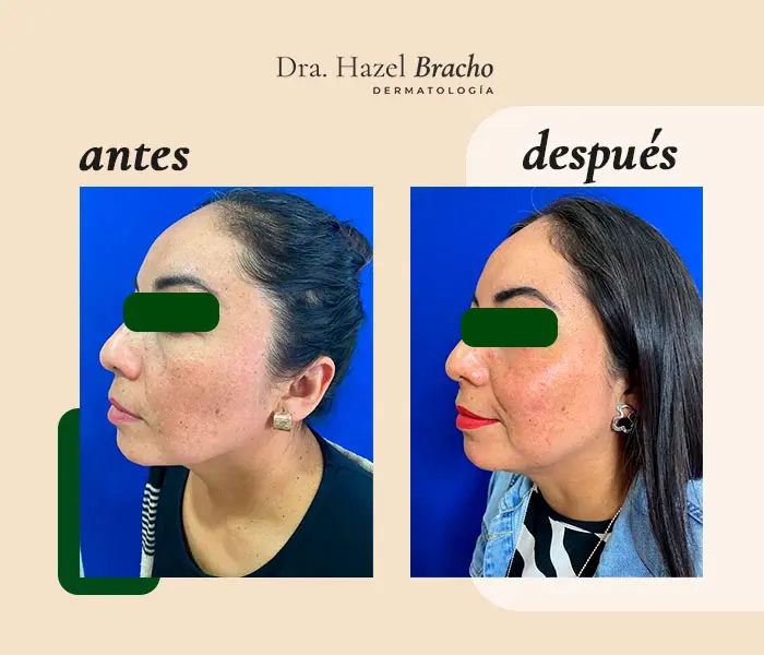 Antes y después de tratamiento dermatológico, caso 4
