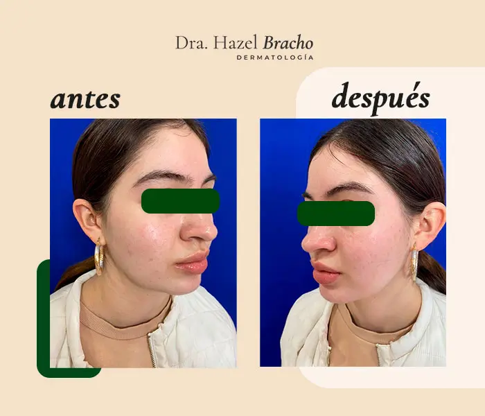 Antes y después de tratamiento para la salud de la piel, caso 1
