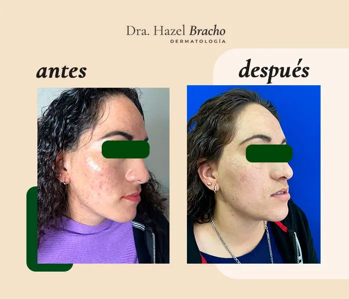 Antes y después de tratamiento para la salud de la piel, caso 2