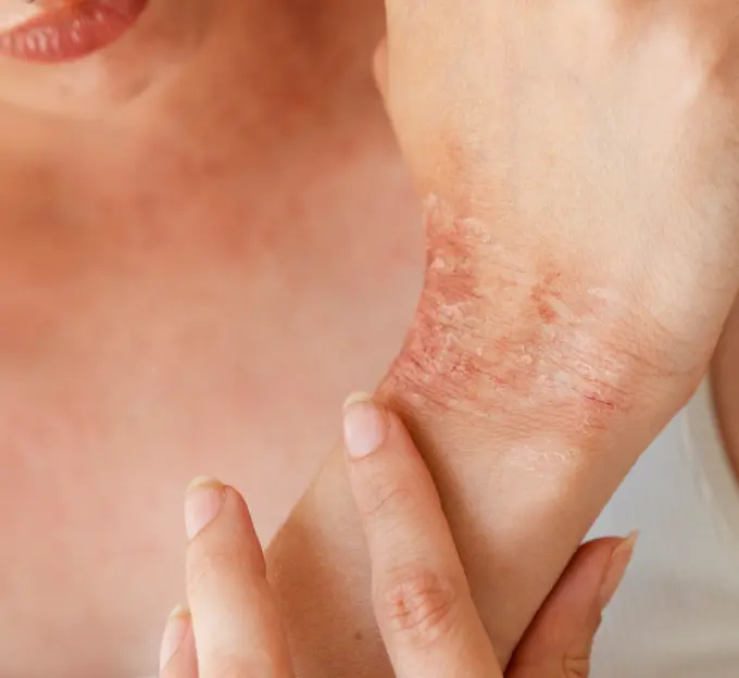 Piel con dermatitis atópica