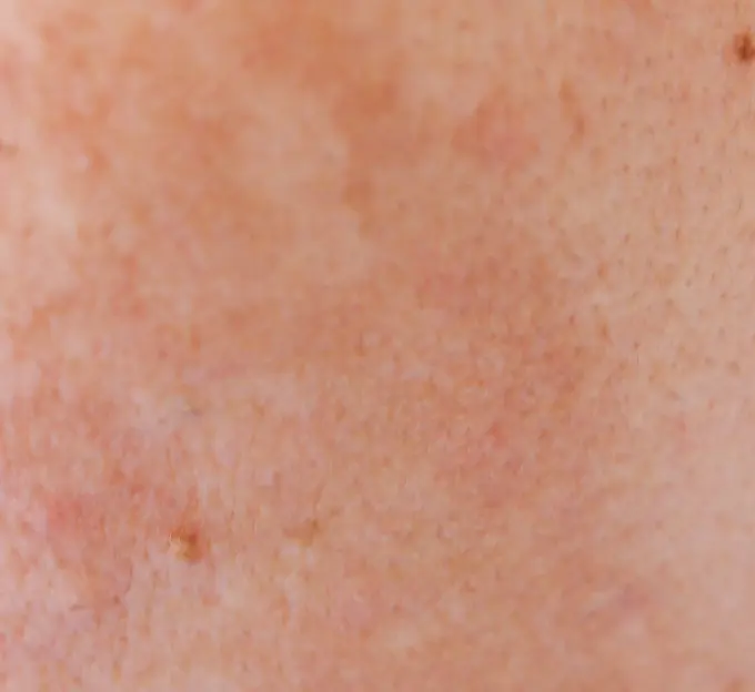 Piel con melasma y daño solar