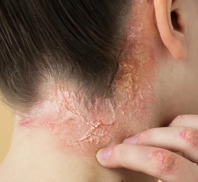 Piel con psoriasis